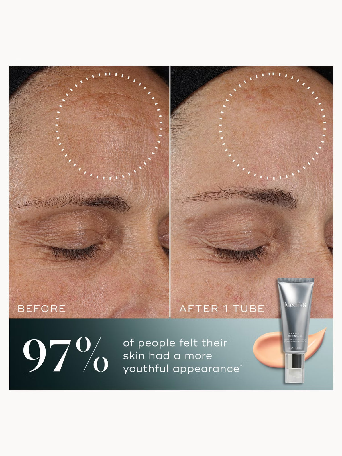 MEDIK8 CRYSTAL RETINAL 10